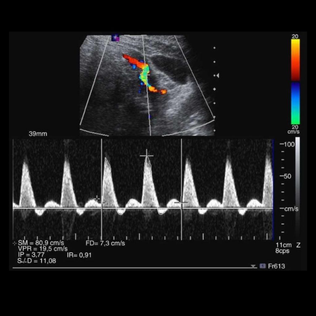 Doppler de arterias uterinas en eco 20 semanas Cool Dreams blog