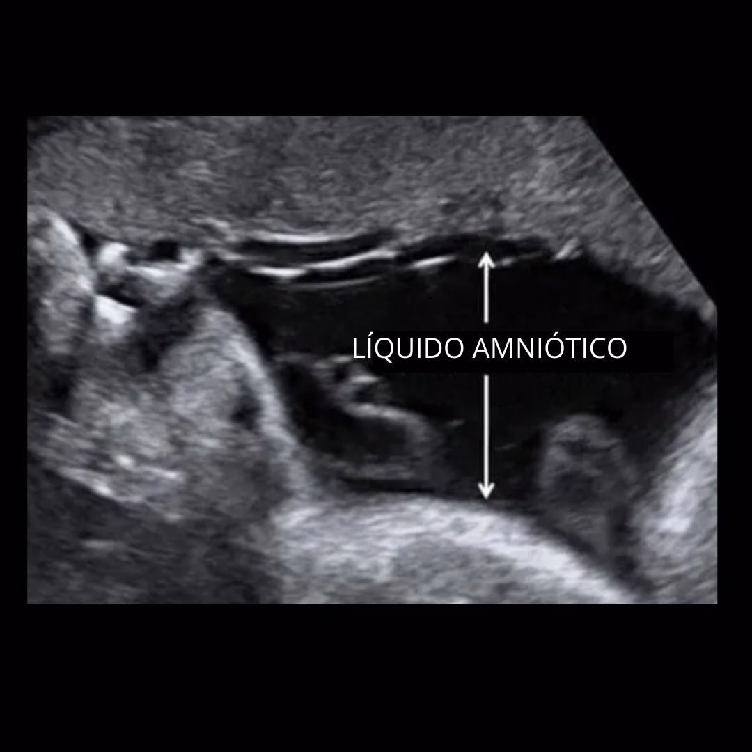 Líquido amniótico en eco 20 semanas CoolDreams blog